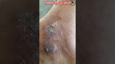 Eczema ठीक हो जाएगी 10 1772392851 maxresdefault