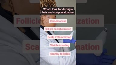 A hair and scalp evaluation detects any signs of hair loss or scalp inflammation! #hairlossexpert 8 1772393889 maxresdefault